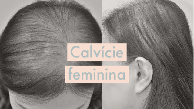 Como detectar a queda de cabelos e calvície feminina 