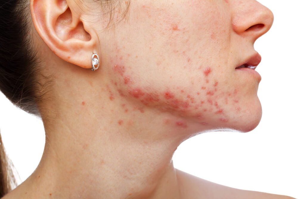 acne em mulheres na fase adulta