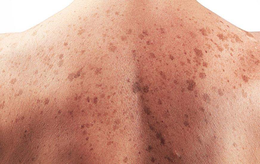 Câncer de pele: um cuidado necessário