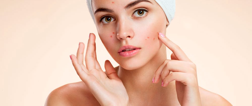 tratamentos contra acne na fase adulta