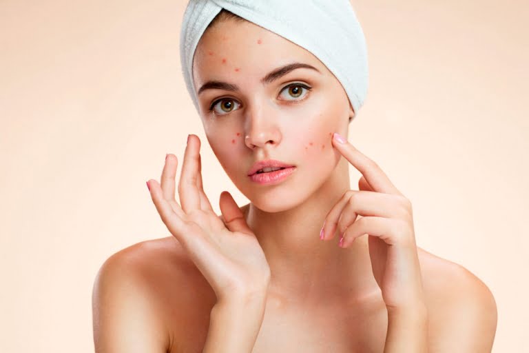 tratamentos contra acne na fase adulta