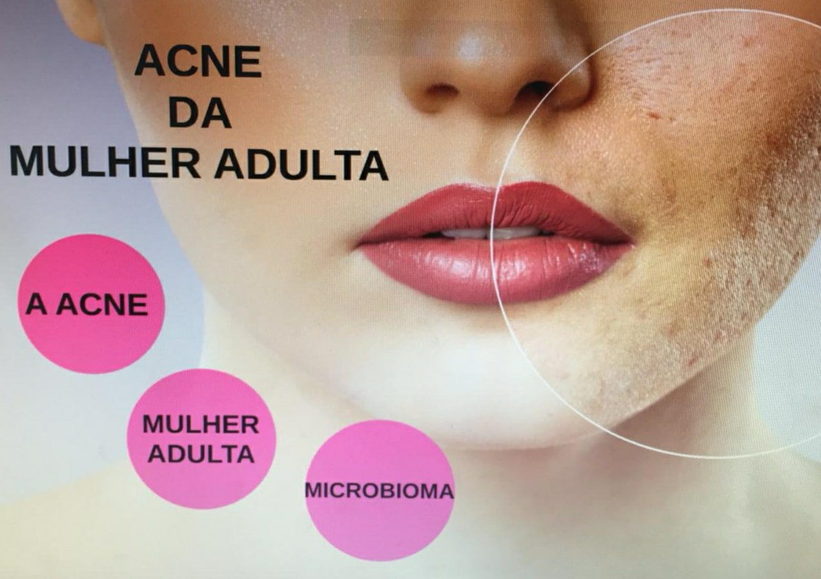 acne-da-mulher-adulta-dermatologista-dra-larissa-montanheiro