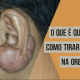 como-tratar-queloide-na-orelha-dra-larissa-montanheiro-dermatologista