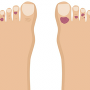 Sintomas do chamado dedos de covid, manifestação cutânea do virus covid19