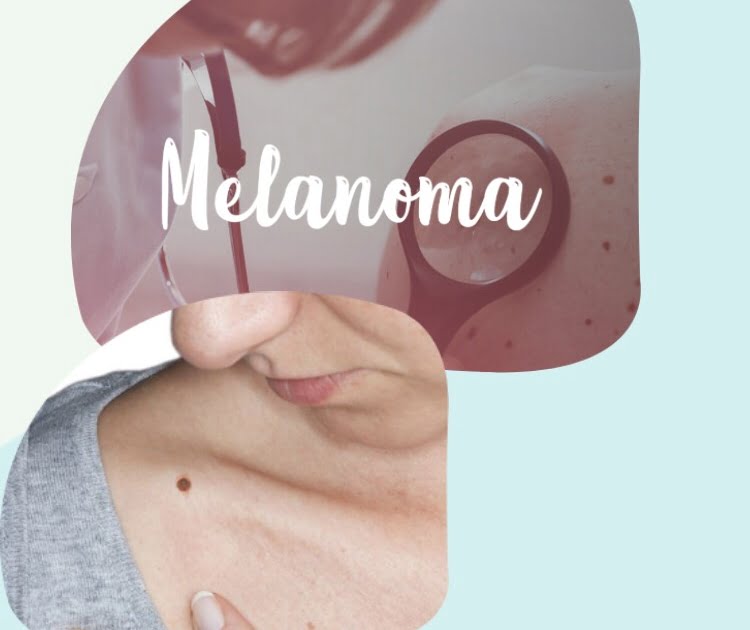 melanoma é um câncer de pele que se origina em manchas e pintas na pele