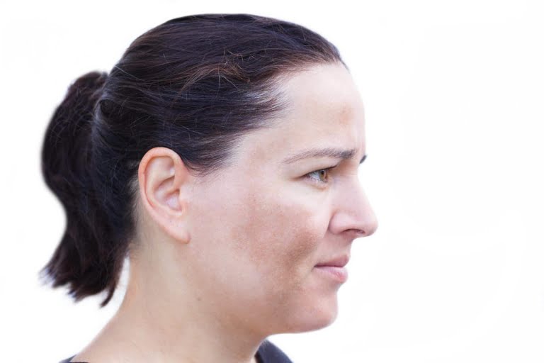 melasma-no-rosto-dra-larissa-montanheiro-dermatologista