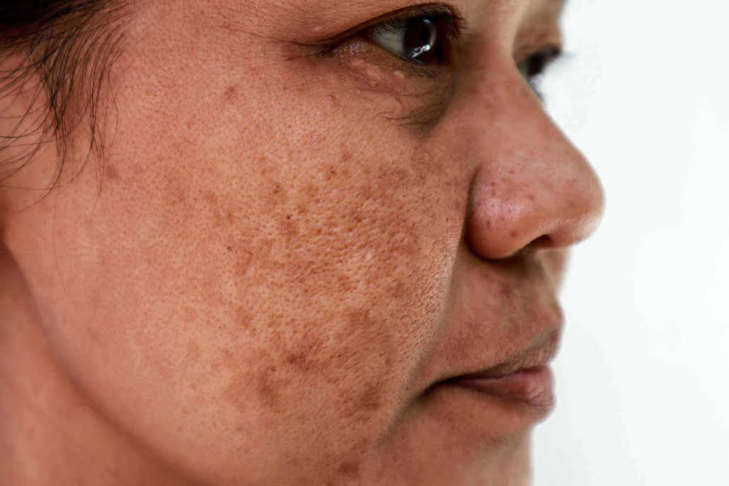 Melasma-como-tratar-Dra-Larissa-Montanheiro-Dermatologista