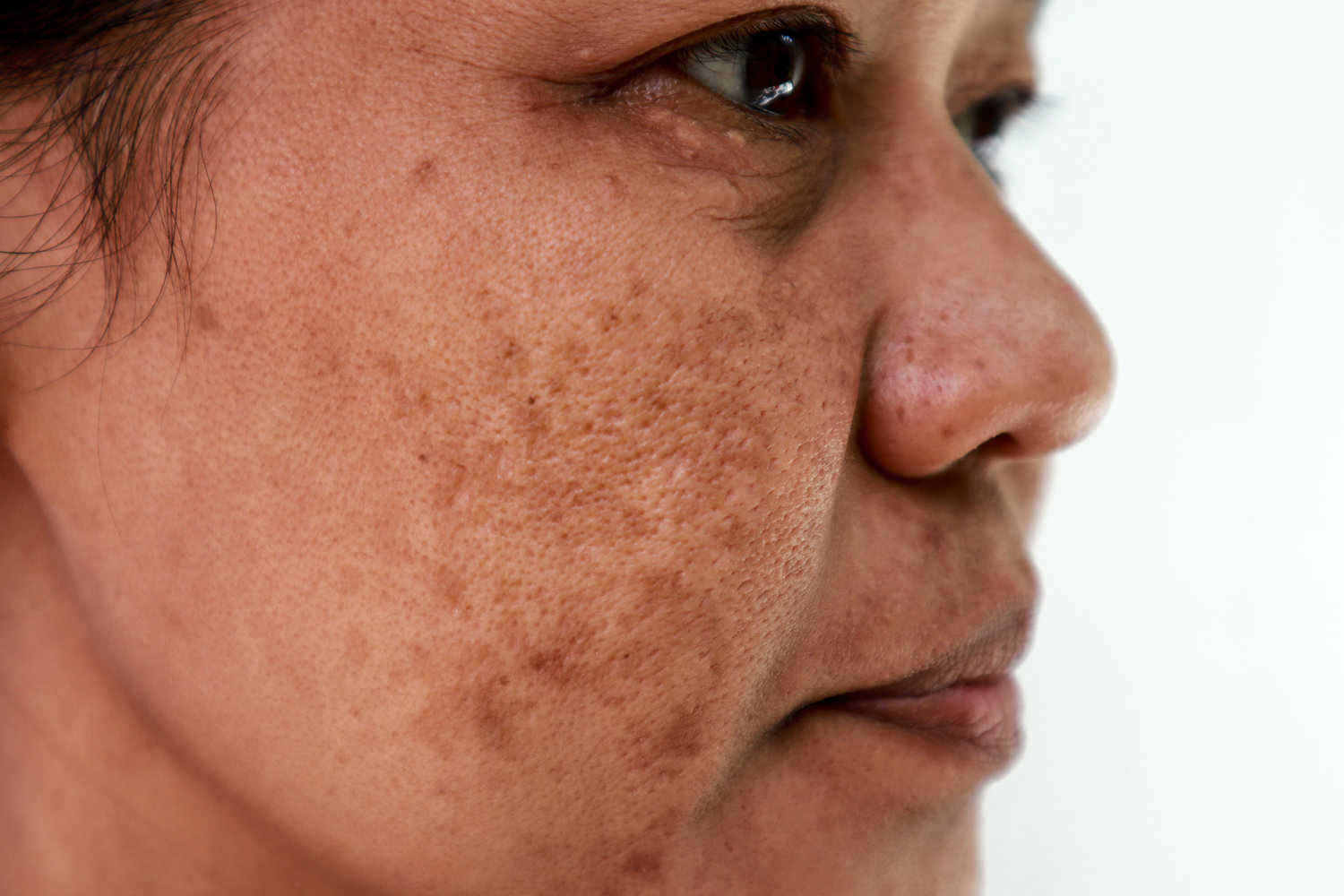 Melasma como tratar - Dra Larissa Montanheiro Dermatologista