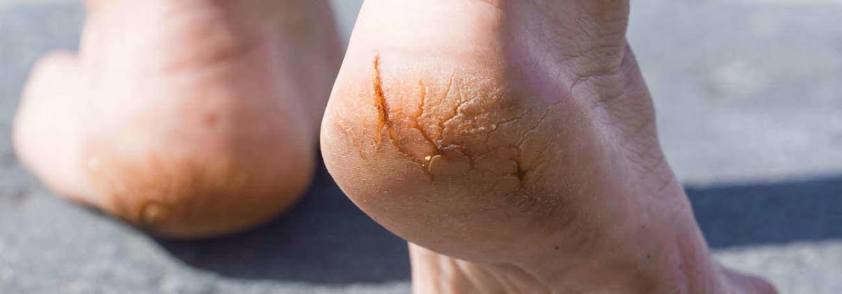 pe-rachado-o-q-fazer-segundo-dermatologista-larissa-montanheiro