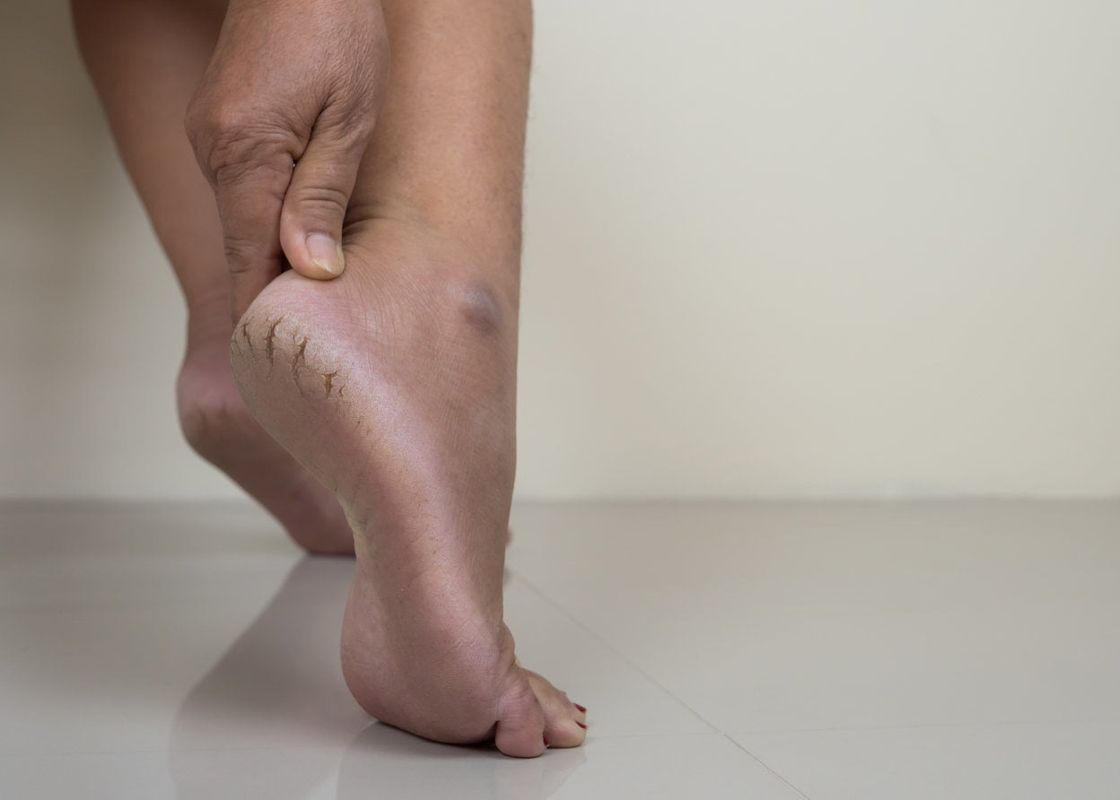 calcanhar-com-pe-rachado-dra-larissa-montanheiro-dermatologista-explica
