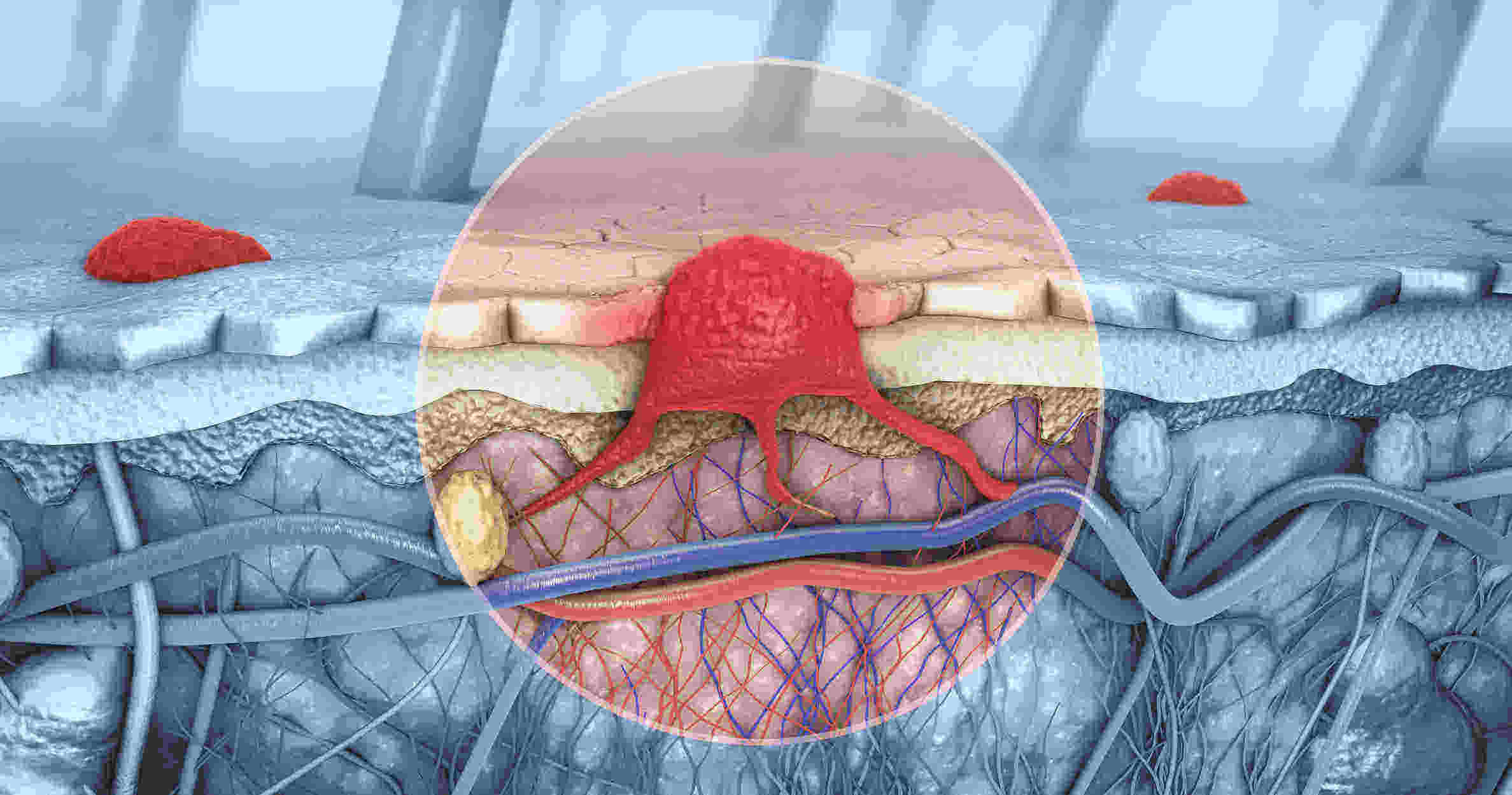 melanoma-perigoso-cancer-de-pele-dermatologista-oncologica-dra-larissa-montanheiro