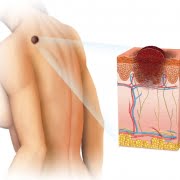 melanoma perigoso câncer de pele sintomas-melanoma-cancer-de-pele-dra-larissa-montanheiro-dermatologista