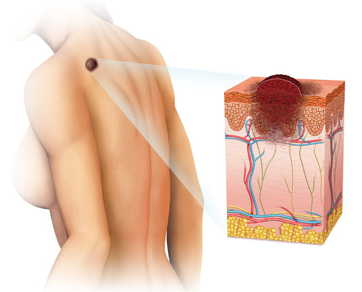 sintomas-melanoma-cancer-de-pele-dra-larissa-montanheiro-dermatologista