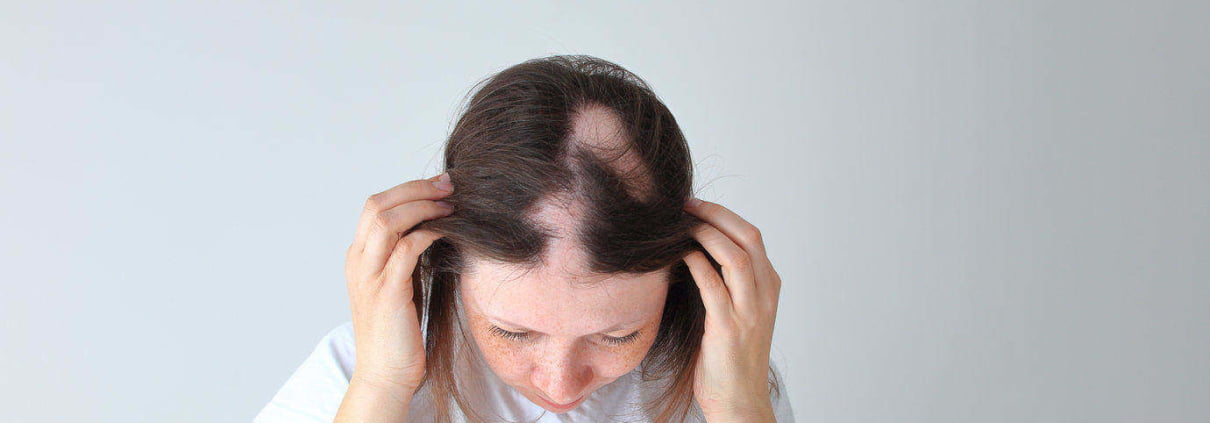alopecia-areata-em-jovem-mulher