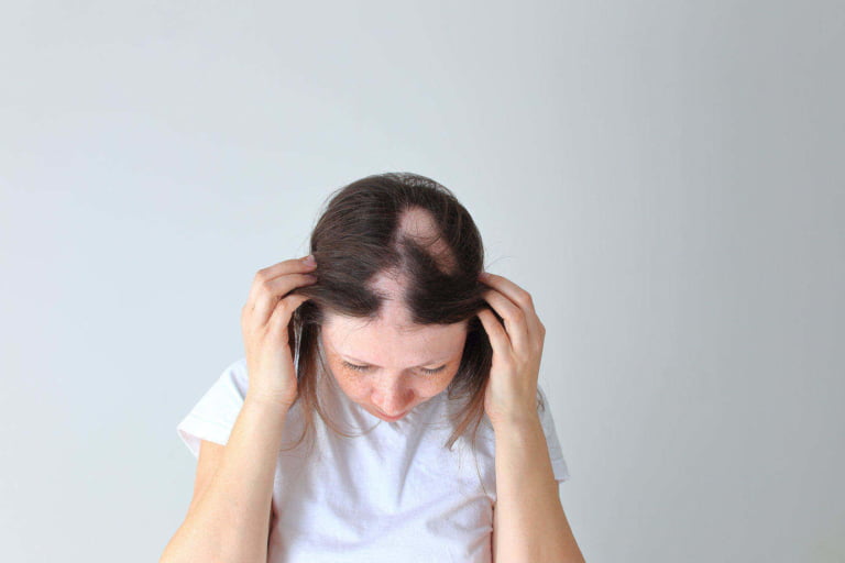 alopecia-areata-em-jovem-mulher