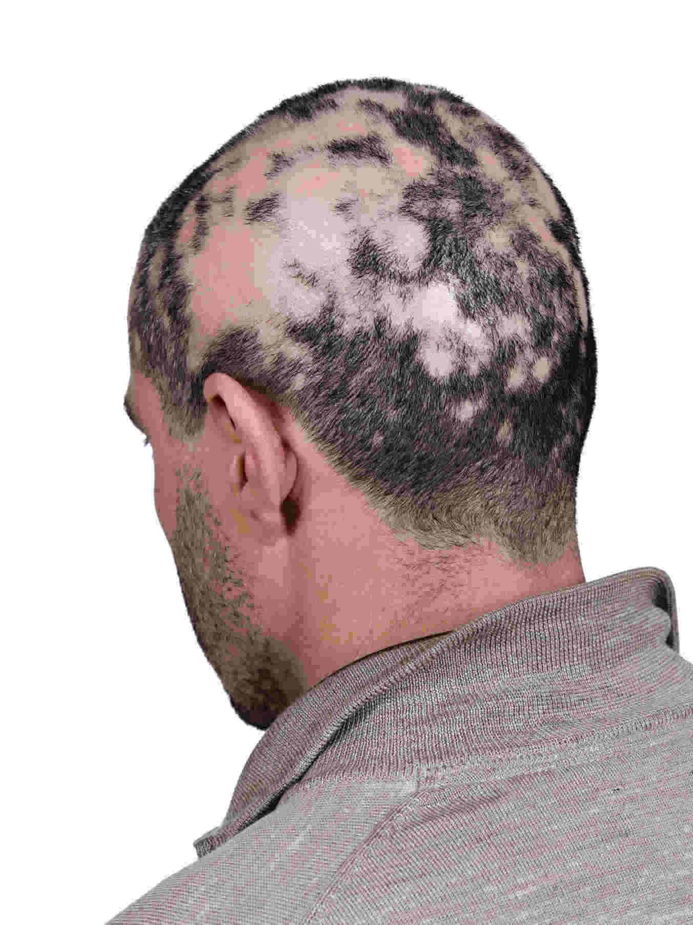 alopecia-areata-extensa-em-homem