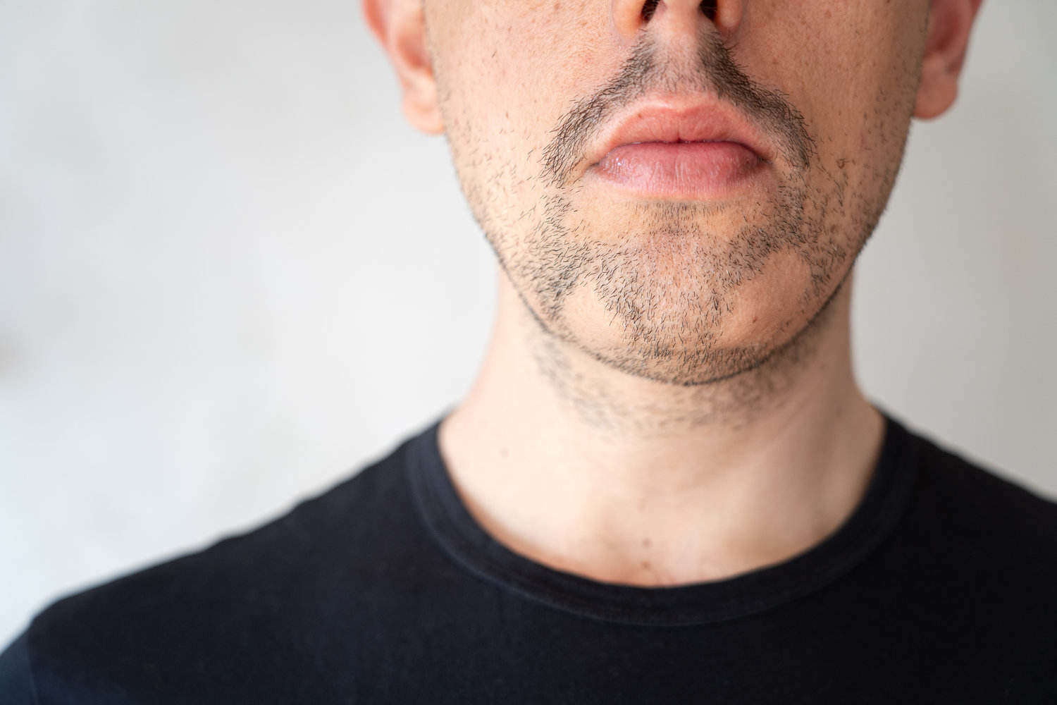 Alopecia areata ataca a barba dos homens