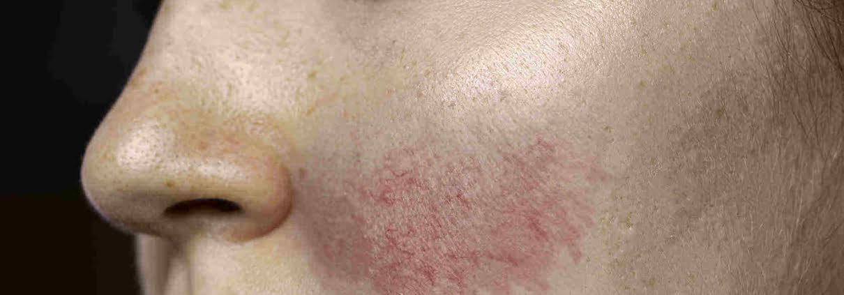 rosace-no-rosto-de-mulher