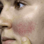 Rosácea no rosto de mulher rosace-no-rosto-de-mulher