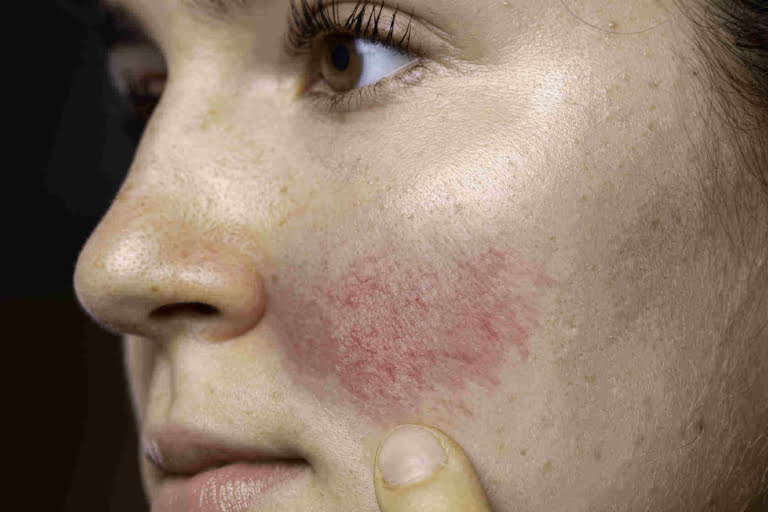 rosace-no-rosto-de-mulher